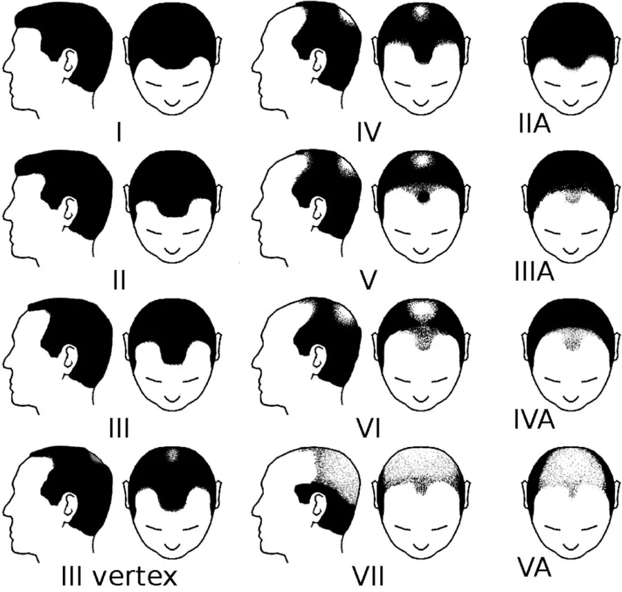 The Hamilton–Norwood scale — the standard staging of male pattern hair loss