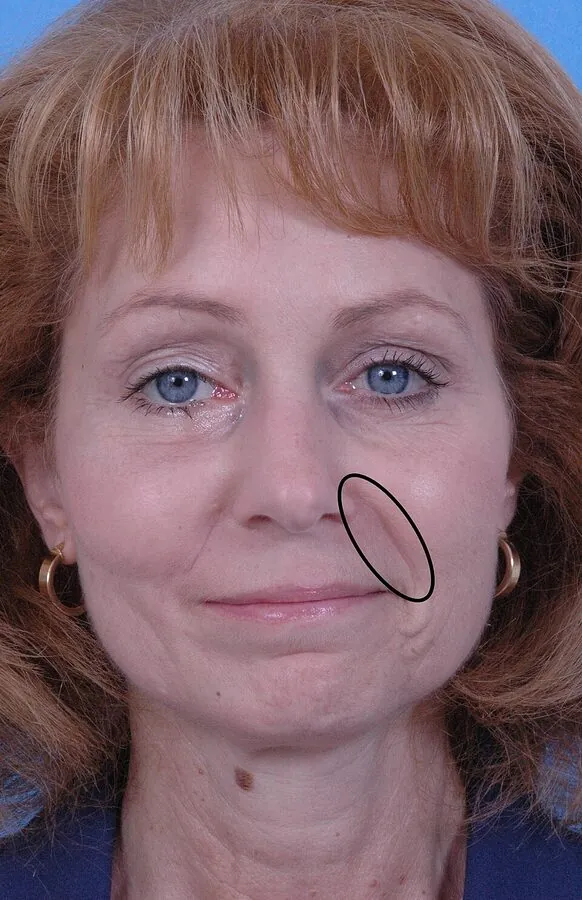 The nasolabial fold (circled) — the crease from nose to mouth corner that deepens with age
