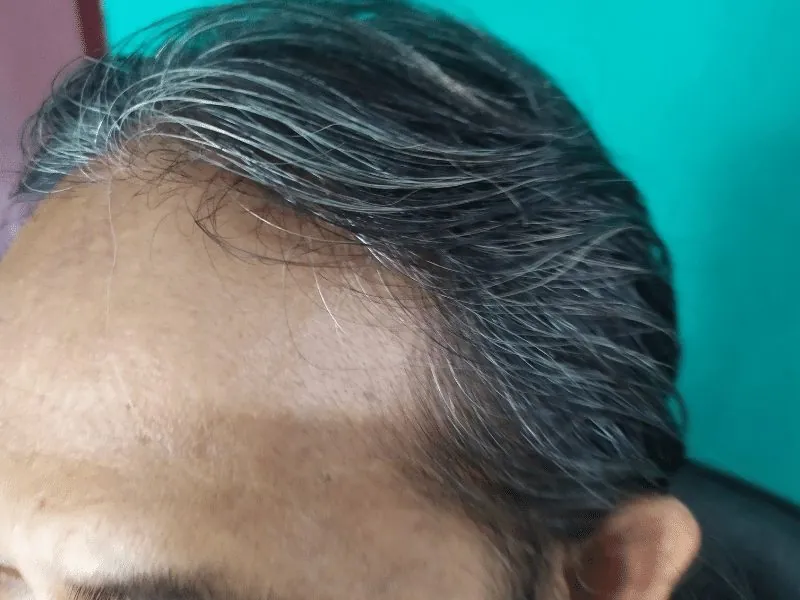 Frontal hairline recession