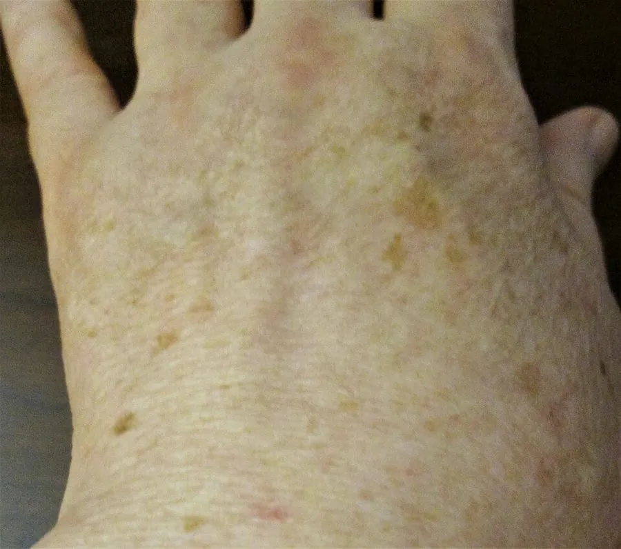 Widespread lentigines over the trunk and arms