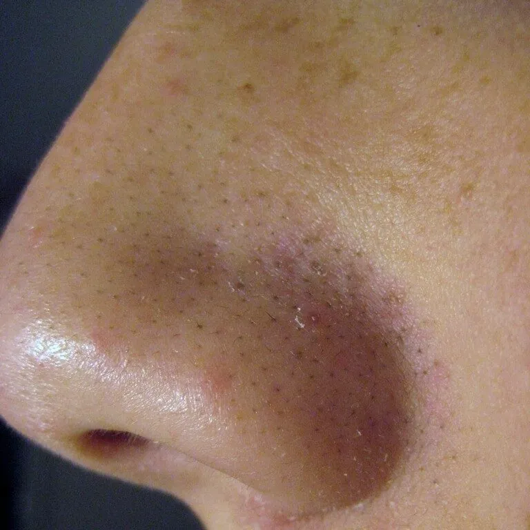 Enlarged, congested pores and blackheads over the nose