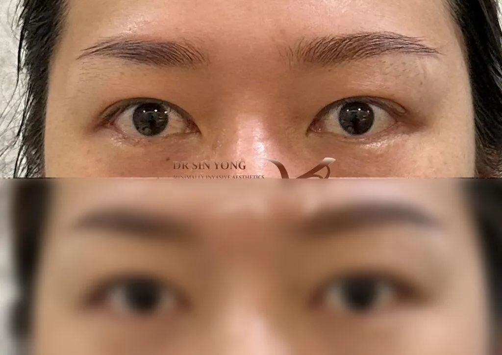 FSX laser non-surgical eye lift for droopy eyelids, before and blurred-after
