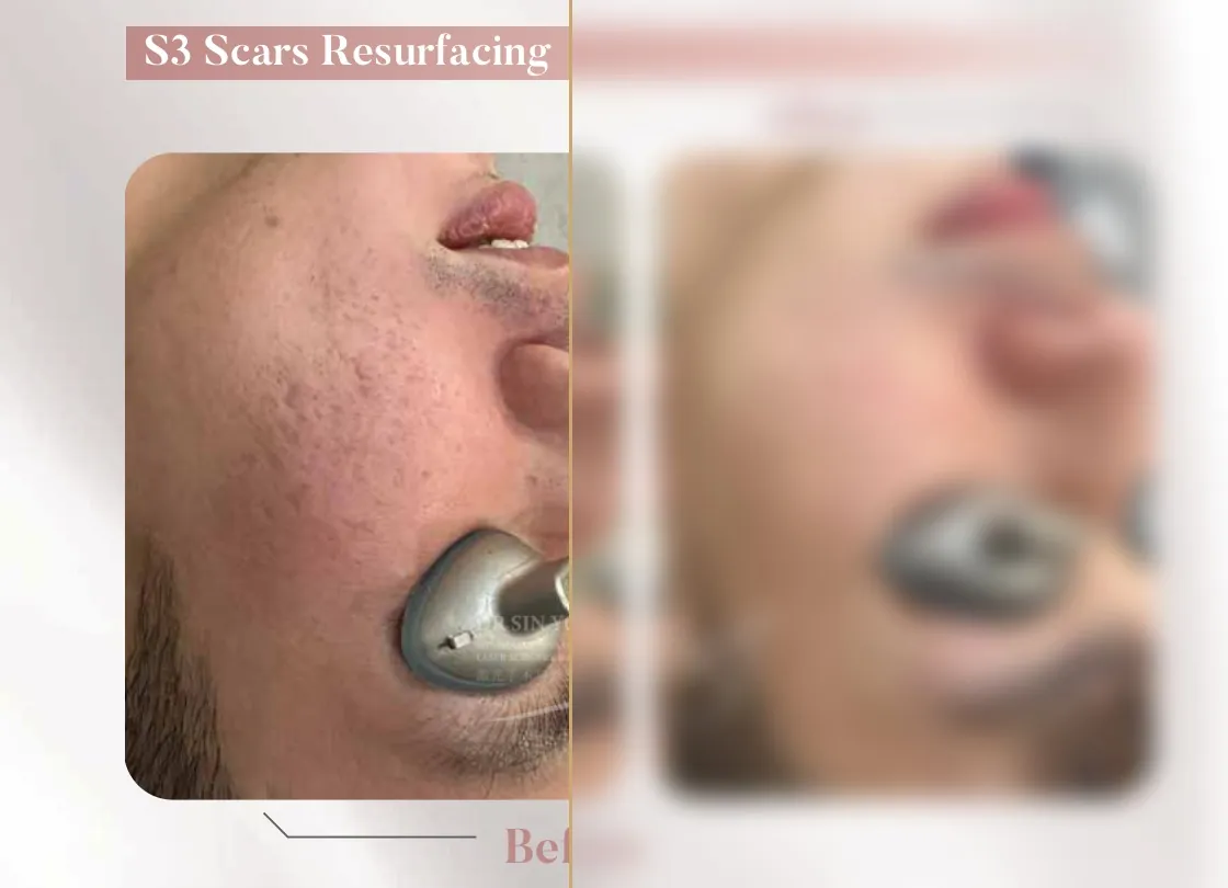 S3 Resurfacing Lift Laser — Scars Resurfacing