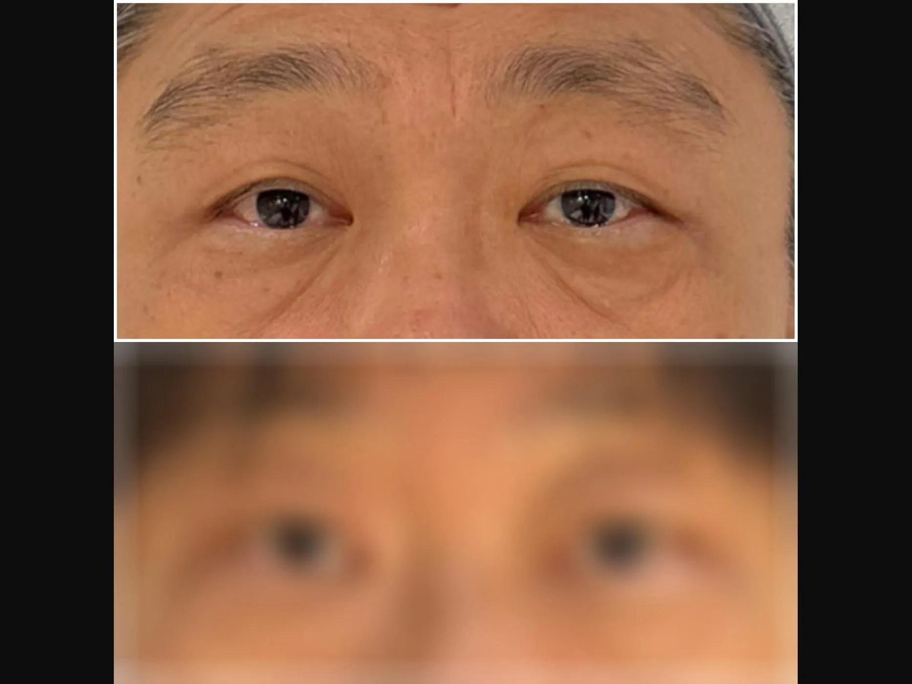 VF Periorbital Eyelift — lifts droopy eyelids, before and blurred-after